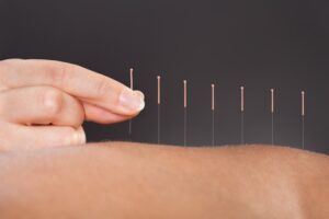 Terapias complementarias: la acupuntura al servicio de la esclerosis múltiple