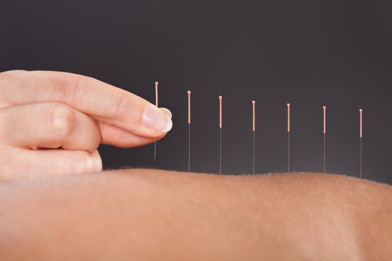 Terapias complementarias: la acupuntura para esclerosis múltiple