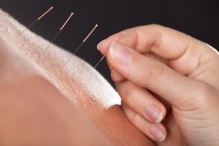 Teràpies alternatives: l'acupuntura al servei de l'EM