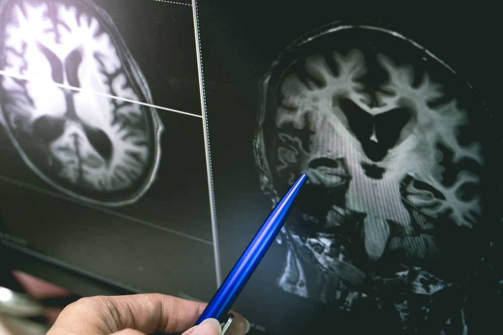 qué es la Atrofia cerebral síntomas esclerosis múltiple