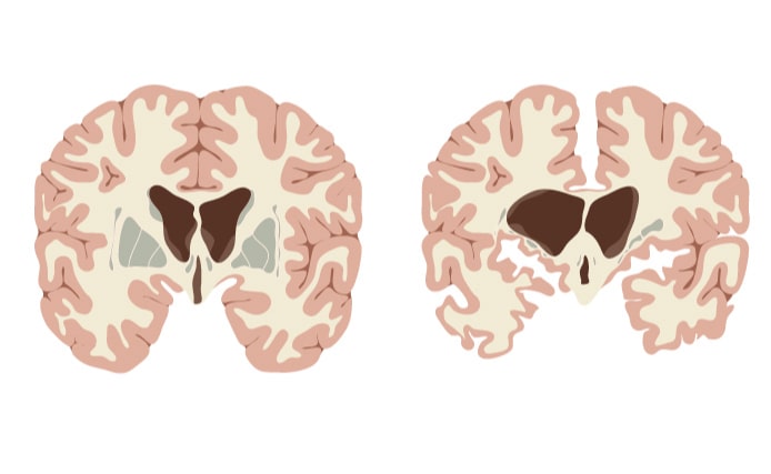 dos cerebros, uno de ellos con atrofia cerebral