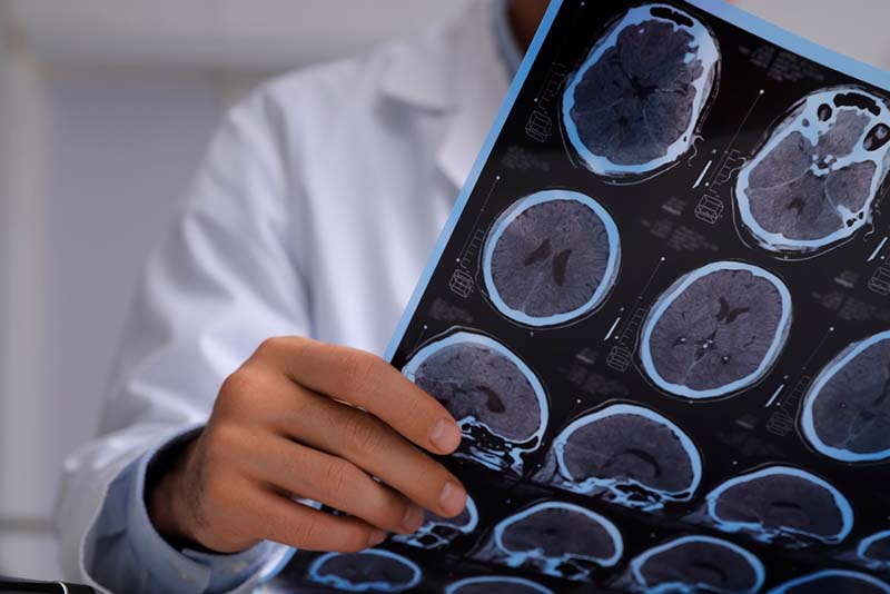 Lesions desmielinitzants cerebrals: en què consisteixen