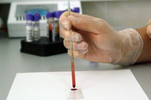 analisi de sang biomarcadors esclerosi múltiple